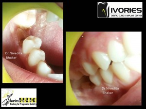 DR NIVEDITA PACHORI,MDS PROSTHODONTIST PERFORMING HANDS-ON SURGERY   